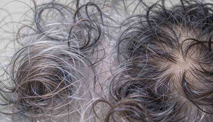 Laser Hair Loss Treatment Singapore How Effective are the Treatment