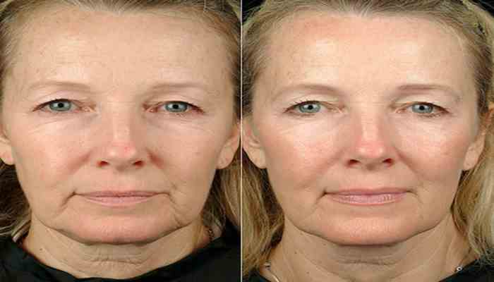 How Long do Thermage results last?