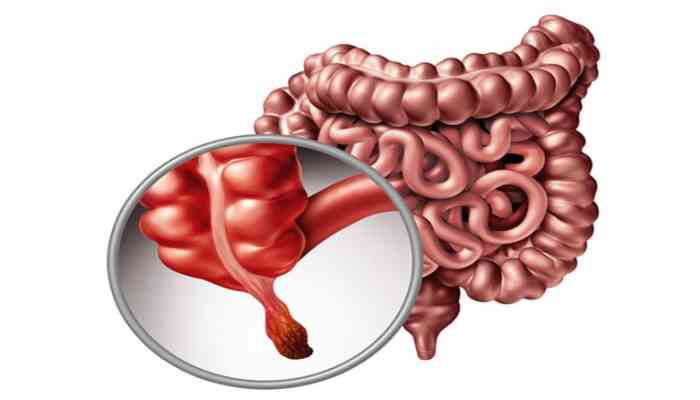 Appendicitis Surgery Singapore: How Long can you Delay it?