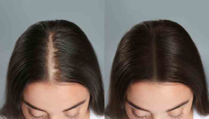 Does Regenera Activa Really Regrow Hair?