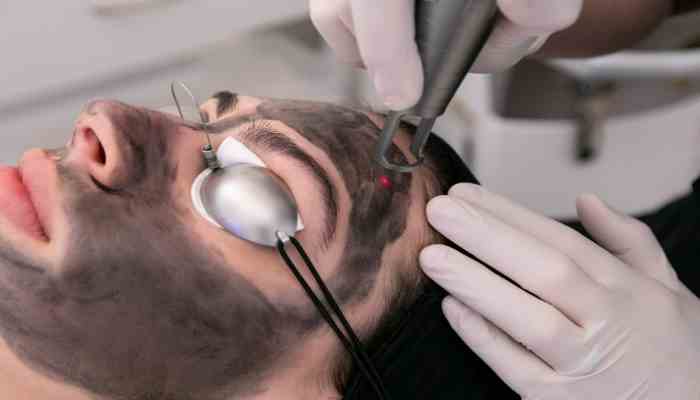 Hollywood Laser Peel: The Glow-Up Treatment Redefining Skin Rejuvenation