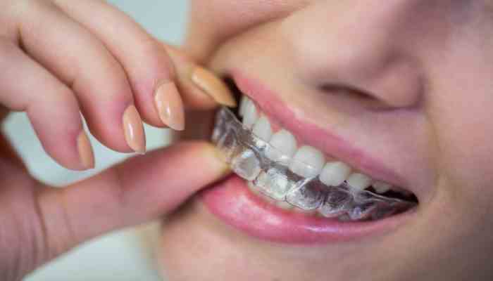 Invisalign in Singapore: A Modern Path to a Healthier, Straighter Smile