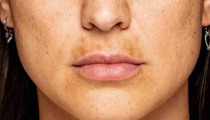 Keep Melasma at Bay: How to Prevent Recurrence After Successful Treatment