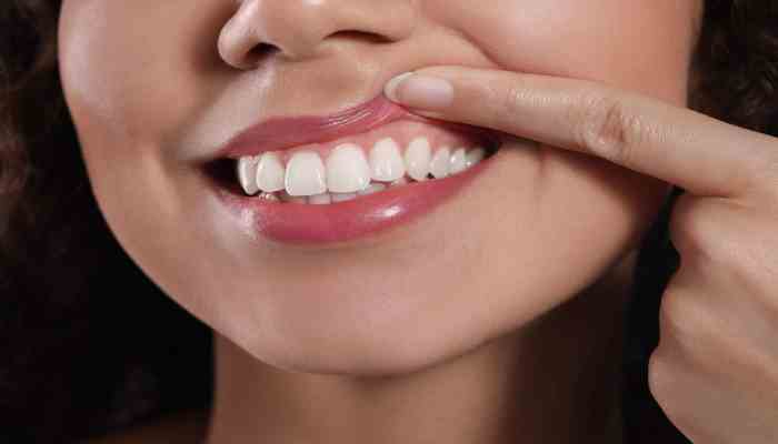 Protect Your Smile: Avoid Teeth Whitenings Trends