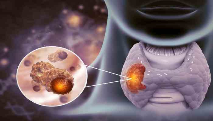 Thyroid Cancer Treatment in Singapore: Making Informed Decisions