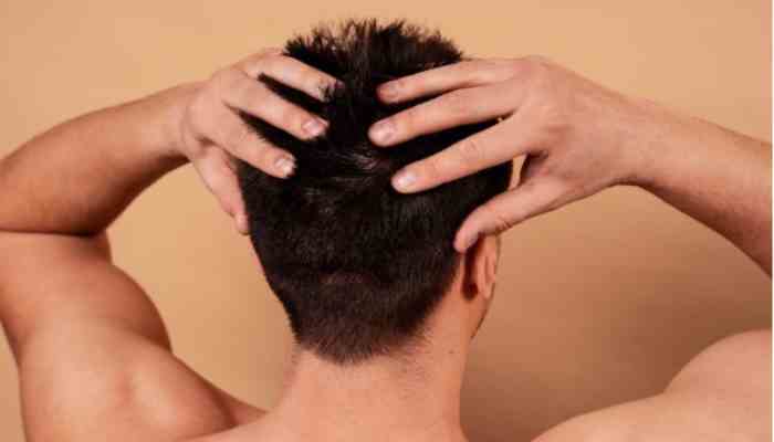 After FUE Hair Transplant