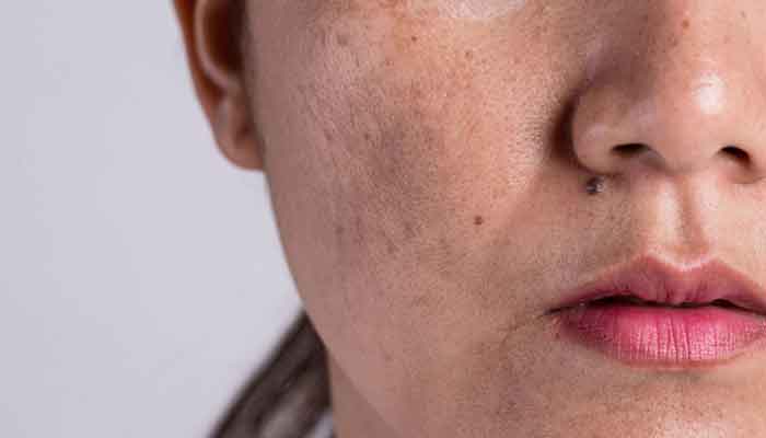 Top Melasma Clinic Options in Singapore