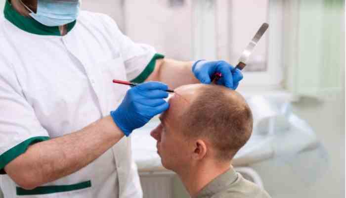 What is FUE Hair Transplant